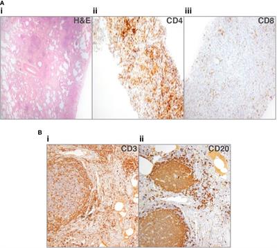 Histology of Interstitial Lung Disease in Common Variable Immune Deficiency